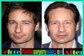 David Duchovny Plastic Surgery Before and After